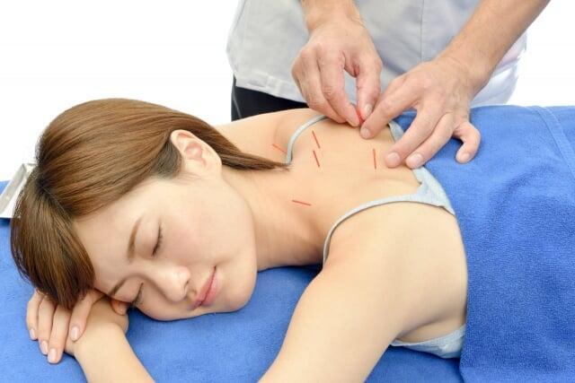 肩まわりの鍼施術のイメージ